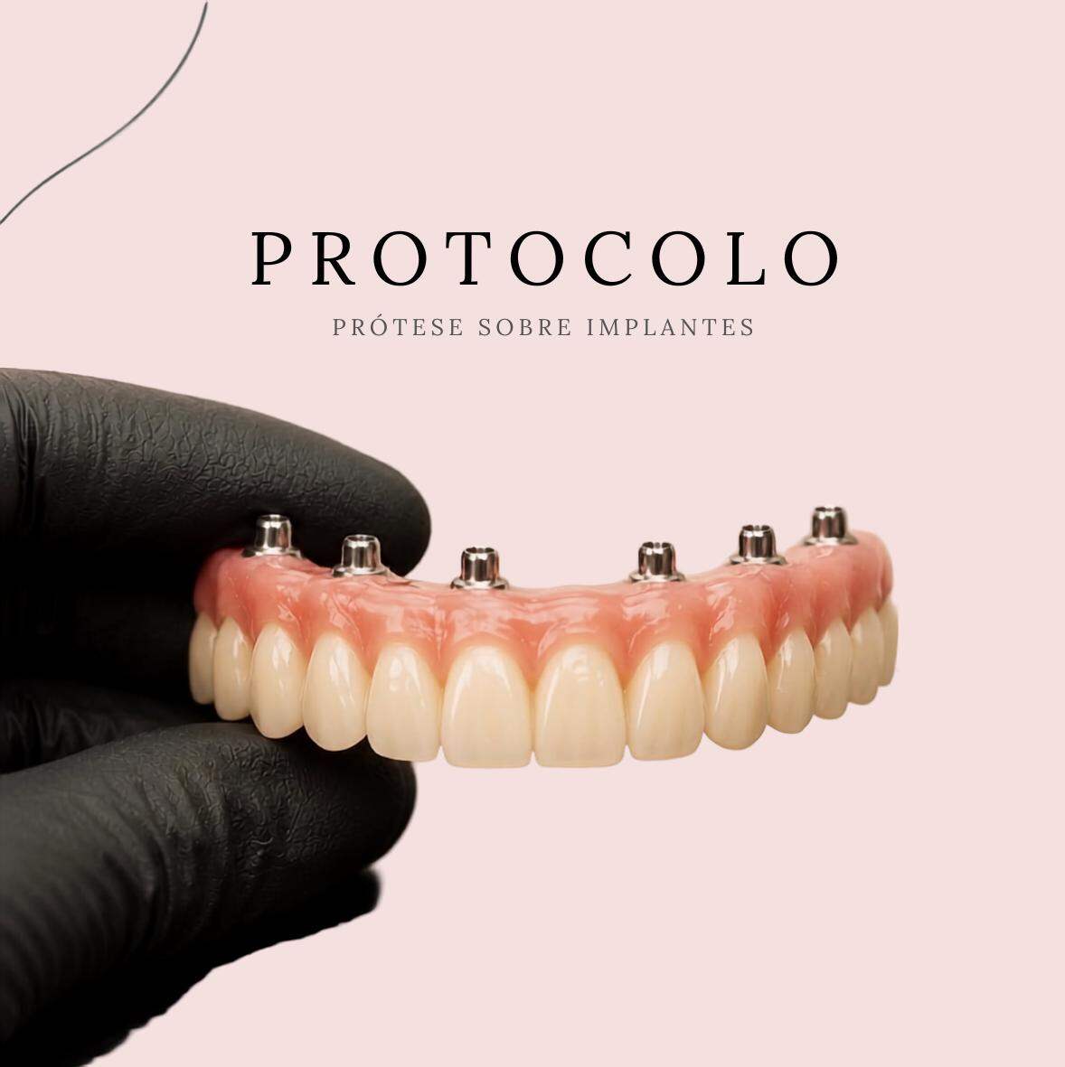 Prótese sobre implantes